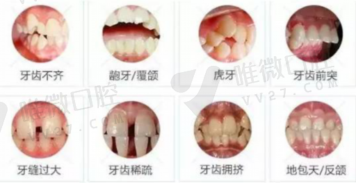 做牙套与假牙区别在哪儿,假牙套是什么样的(图1)